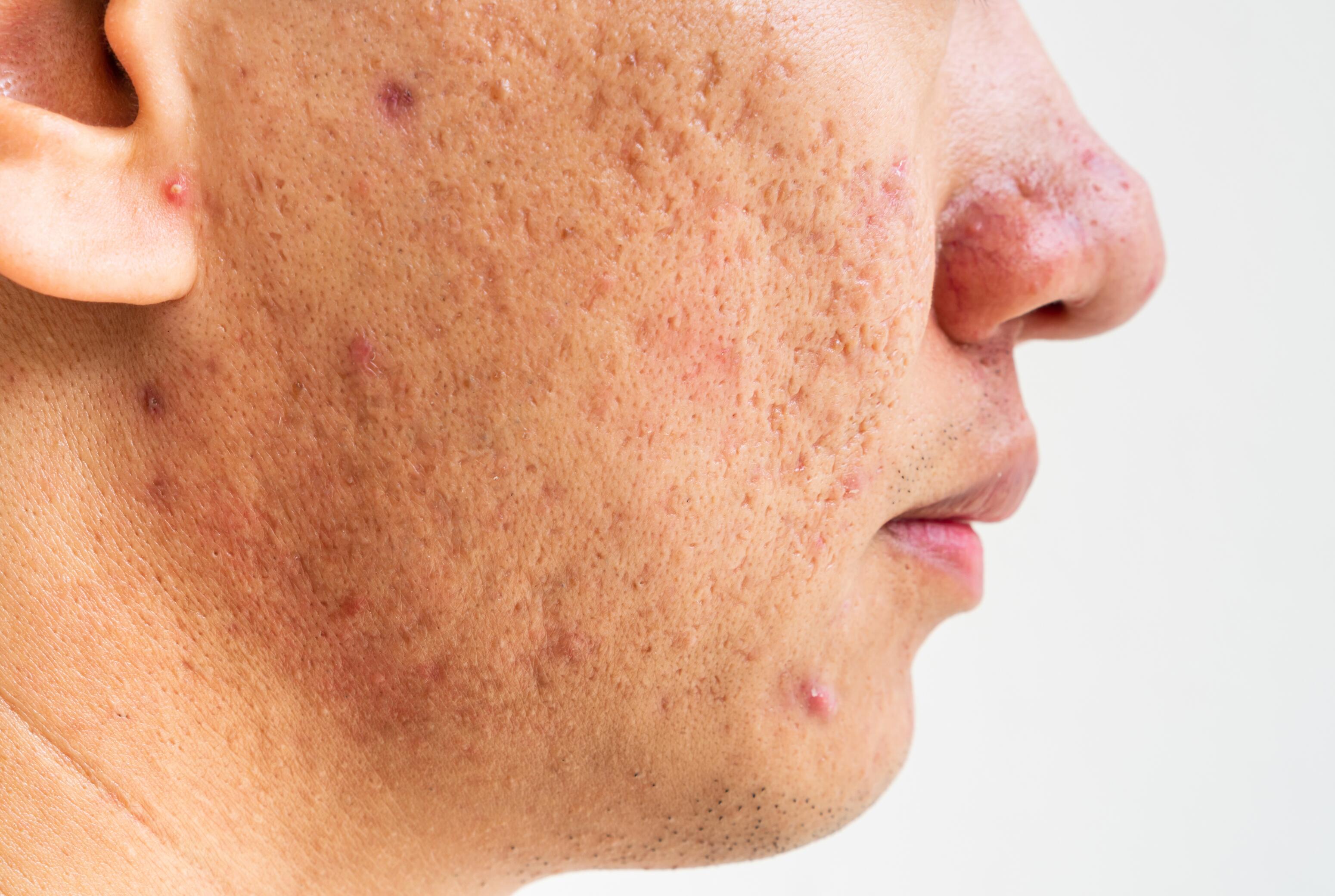 All About Acne Scars and Their Treatments